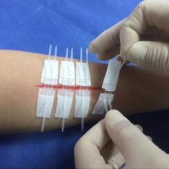 Перевязка EDGE Lock для закрытия ран.